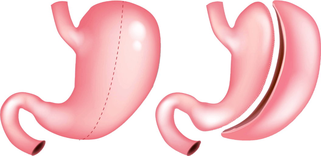 Illustration of how gastric sleeve surgery works using a before and after image of a stomach