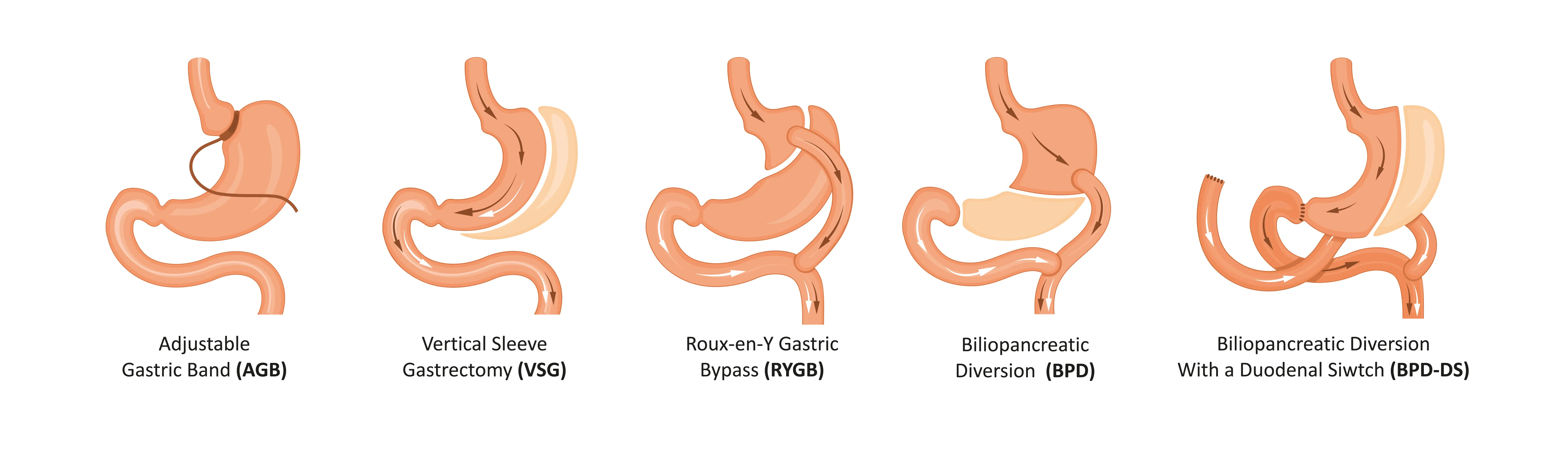 5 different types of bariatric surgery procedures with a visual explanation