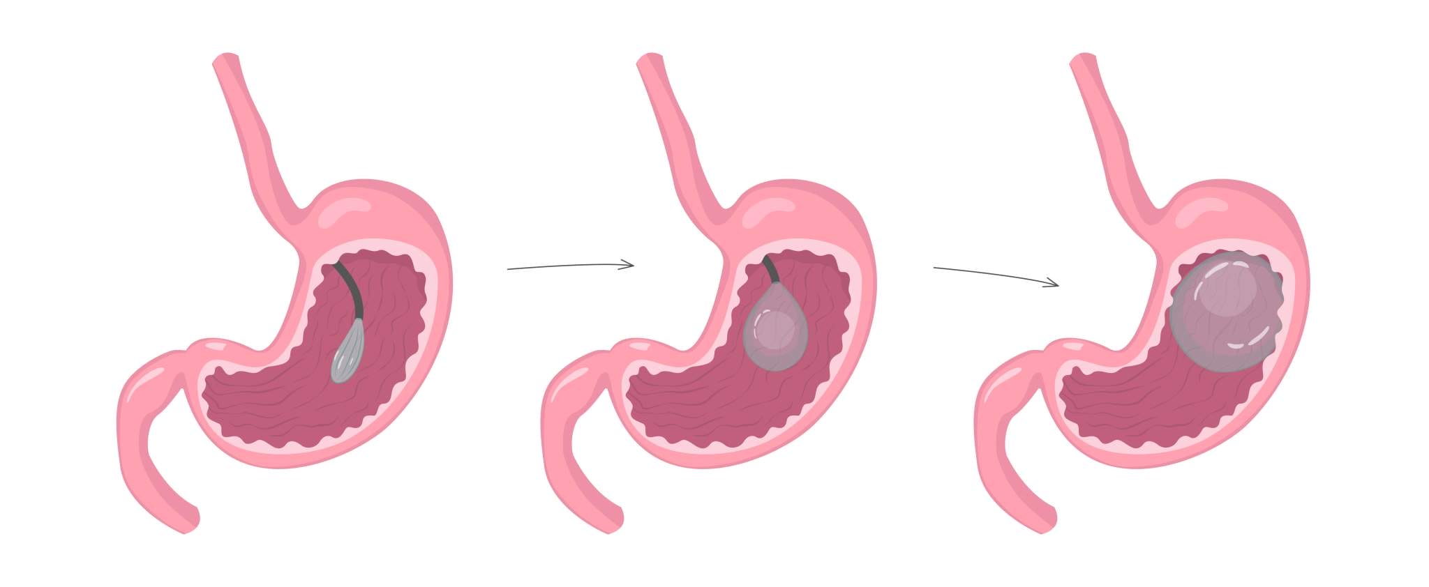 Step-by-step illustration on how the gastric balloon treatment works