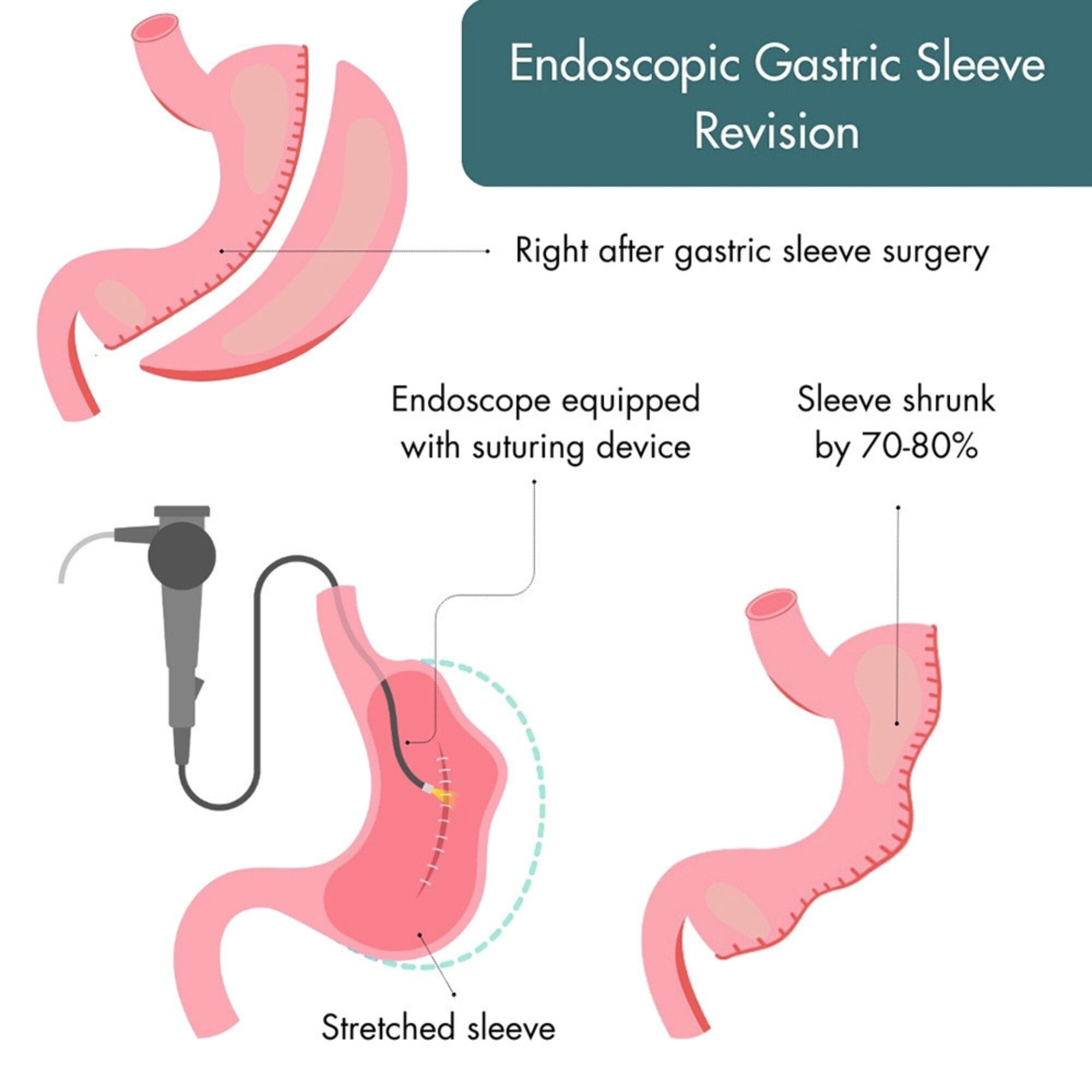 Endoscopic gastric sleeve revision surgery illustration to show a sleeve shrinking by 70-80%